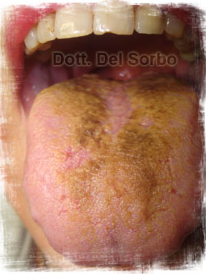 lingua_nigra_villosa