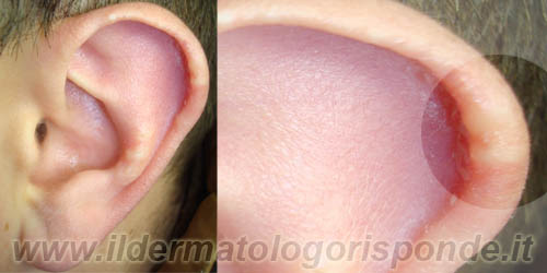 immagini di dermatite con prurito all’orecchio