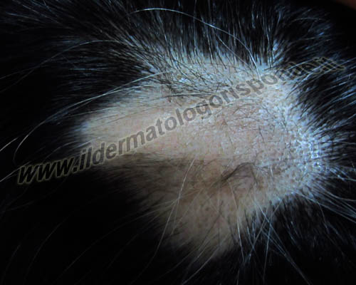 alopecia tricogramma salerno