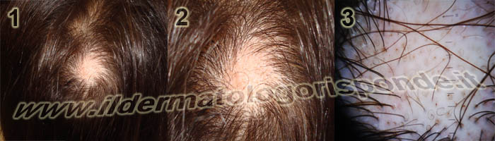 tricoscopia digitale e alopecia