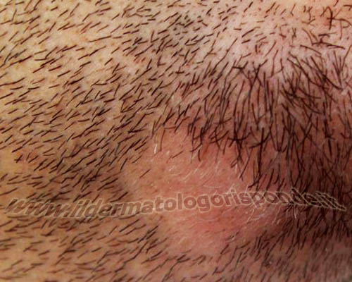 alopecia areata in paziente con dermatite da stress
