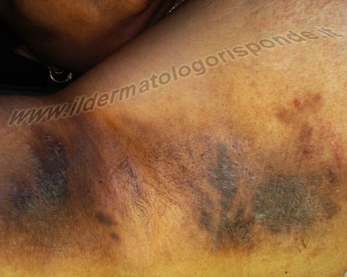 immagini di macchie scure della pelle in paziente affetta da intertrigine ascellare