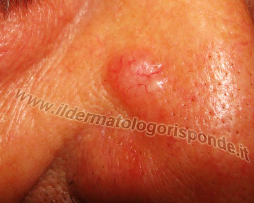 basalioma viso immagine epitelioma basocellulare del viso