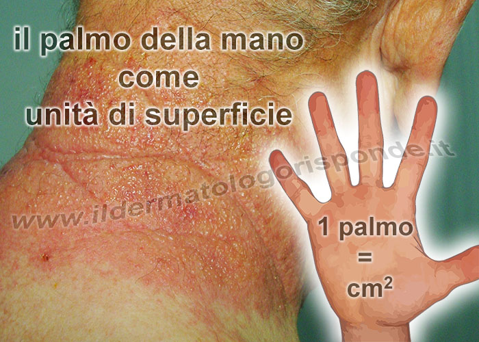 BSA calcola DLQI online Dermatology Life Quality Index, questionario qualità di vita