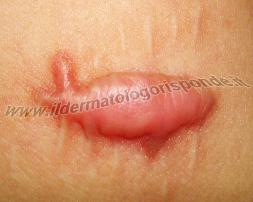 asportazione cheloide