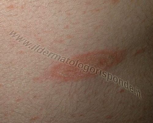 Pitiriasi Rosea Di Gibert Con Immagini Cliniche