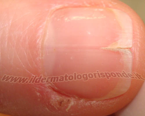 le unghie nel morbo di Darier possono presentare un'intaccatura del margine libero a forma di V rovesciata