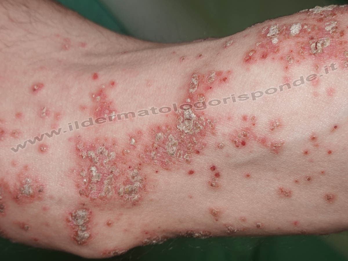 Dermatite Erpetiforme Di Duhring O Celiachia Della Pelle Dermatite Erpetiforme Di Duhring O Celiachia Della Pelle