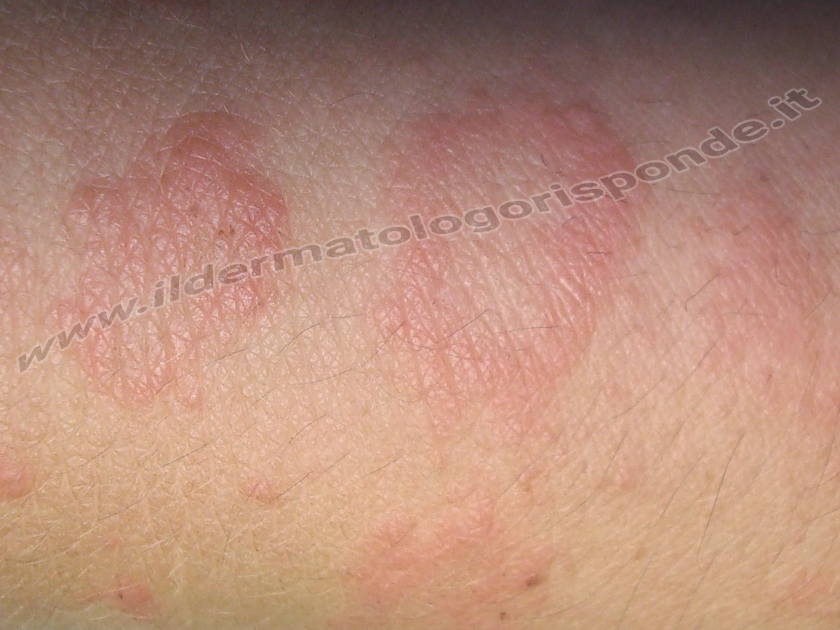 Dermatite Erpetiforme Di Duhring O Celiachia Della Pelle Dermatite Erpetiforme Di Duhring O Celiachia Della Pelle