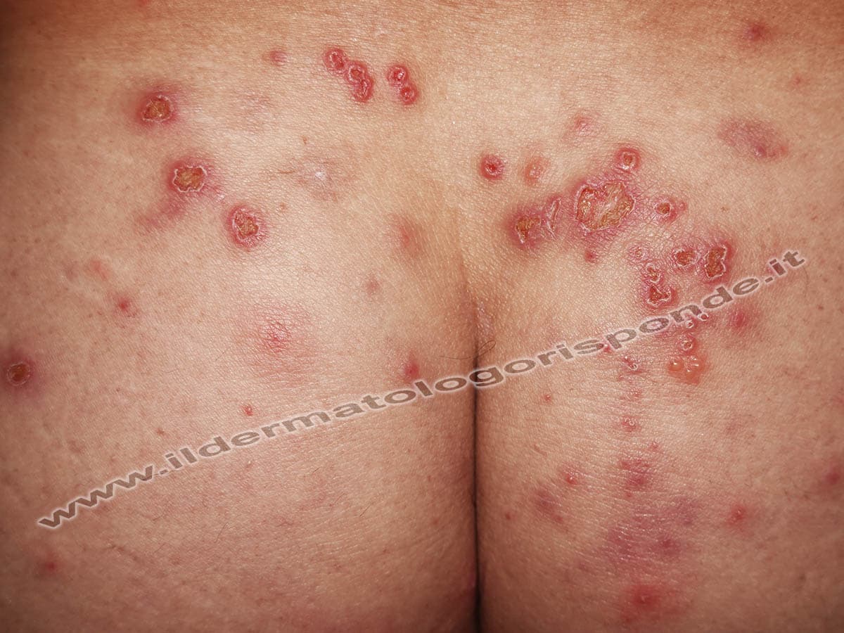 Dermatite Erpetiforme Di Duhring O Celiachia Della Pelle Dermatite Erpetiforme Di Duhring O Celiachia Della Pelle