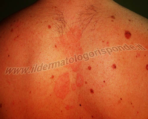Dermatite Seborroica E Altre Cause Di Rossore Al Viso
