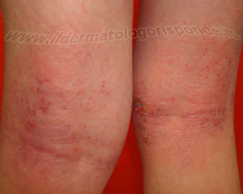 donor Sparkle physically Dermatite da pannolino: allergia o infezione?