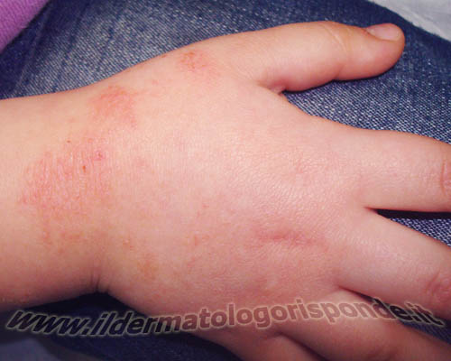 immagini di dermatite atopica alle mani in età pediatrica