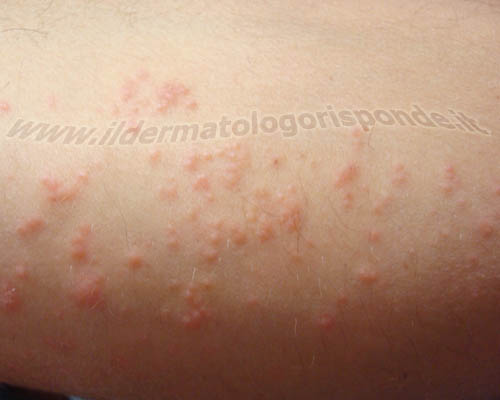 immagine di dermatite del nuotatore o eruzione del bagnante
