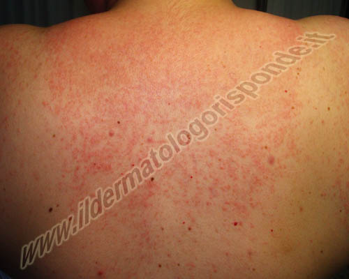 foto di dermatite polimorfa solare localizzata nelle aree fotoesposte del dorso