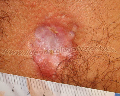 dermatofibrosarcoma protuberans