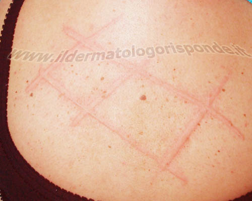 orticaria dermografica e dermografismo positivo