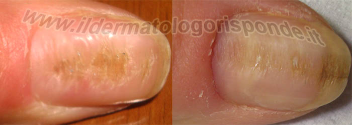 immagini di unghie solcate nella distrofia canaliforme di Heller