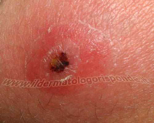 Ectima contagioso ORF