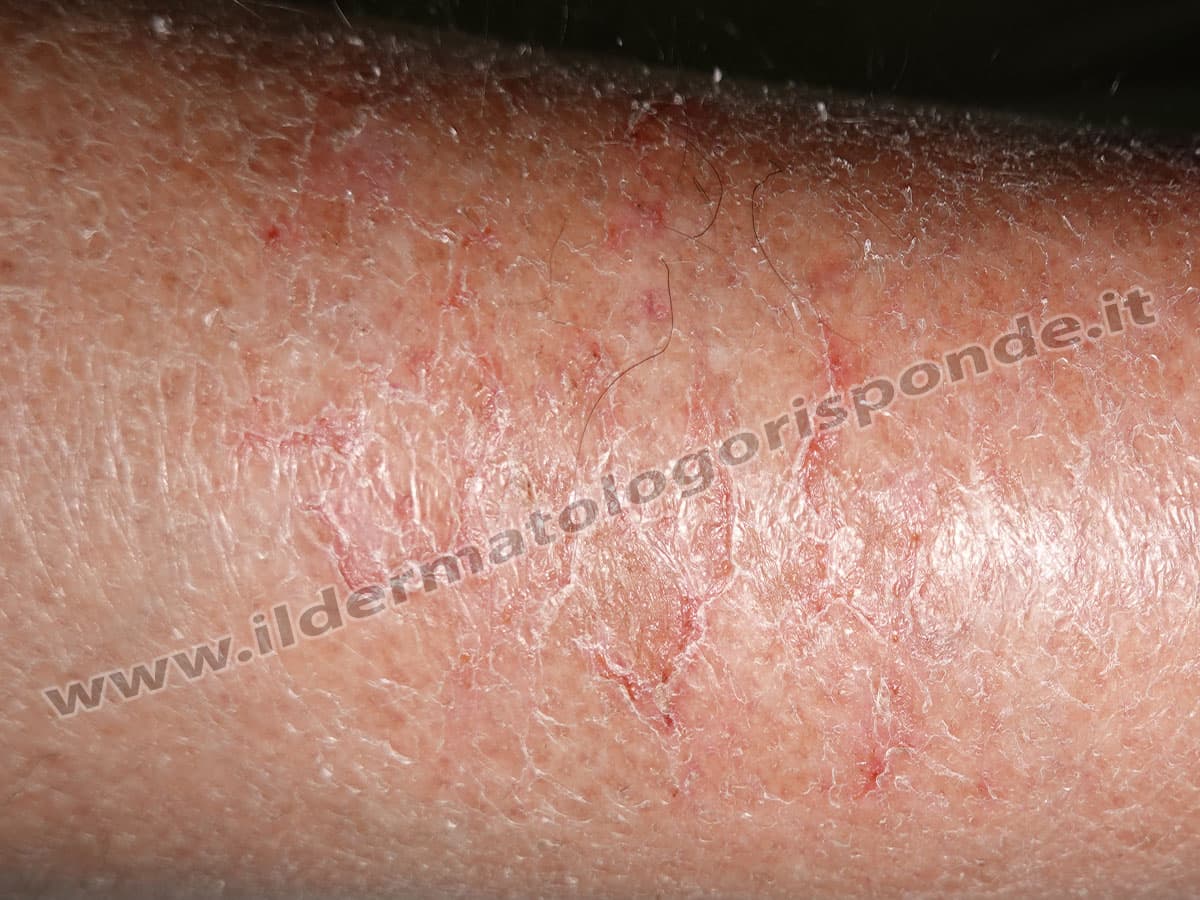 Immagini di eczema asteatosico sulla pelle delle gambe