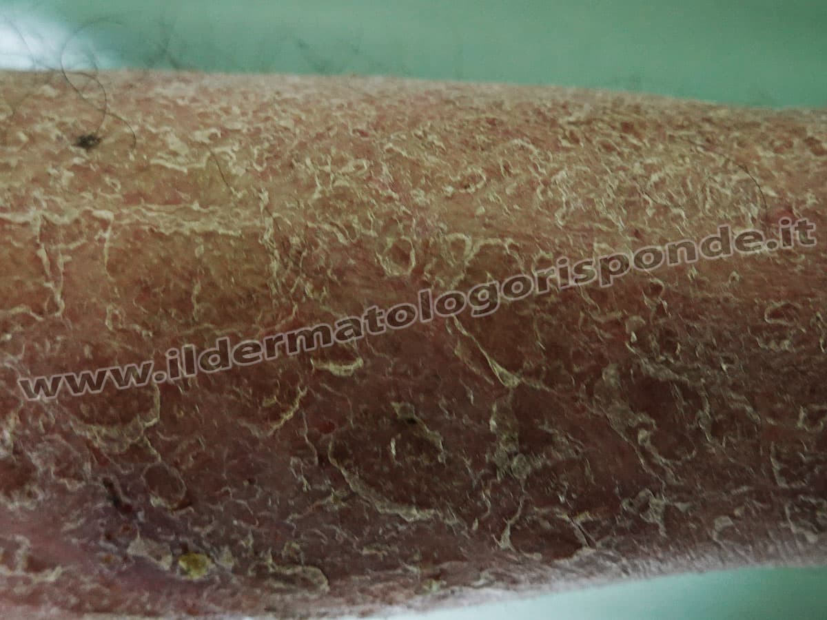 Eczema Asteatosico Dell Anziano O Eczema Craquele