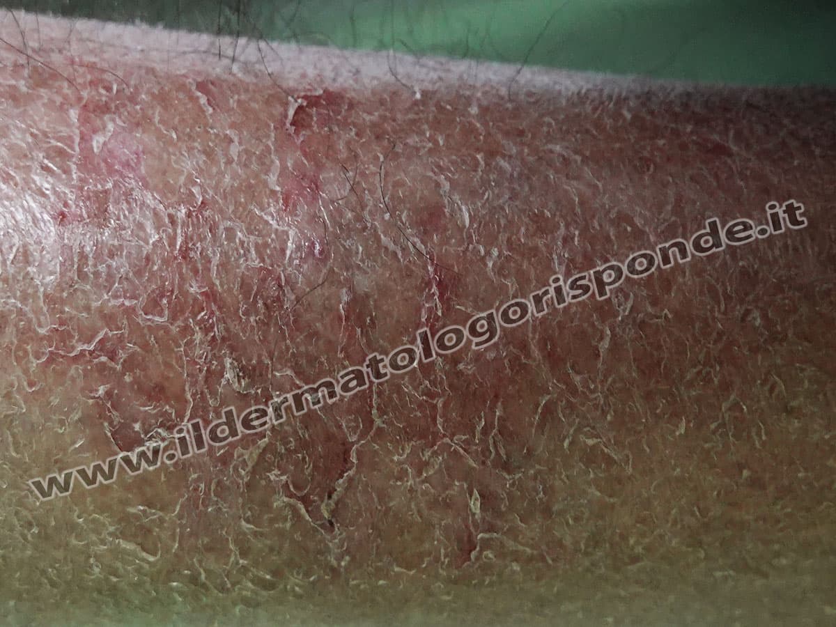 Eczema asteatosico in anziano paziente