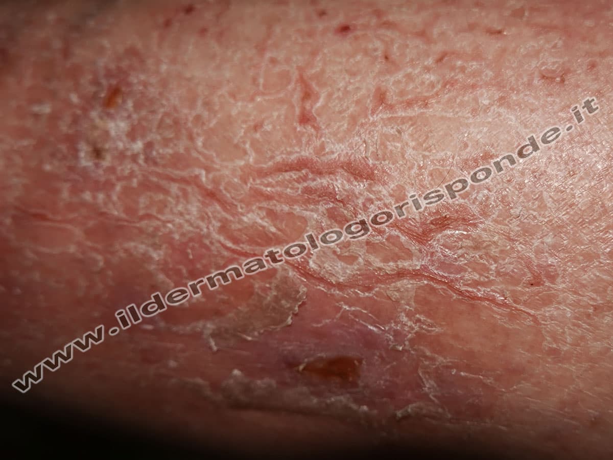 Paziente con eczema craquelé, eczema fendillé o eczema cannellé