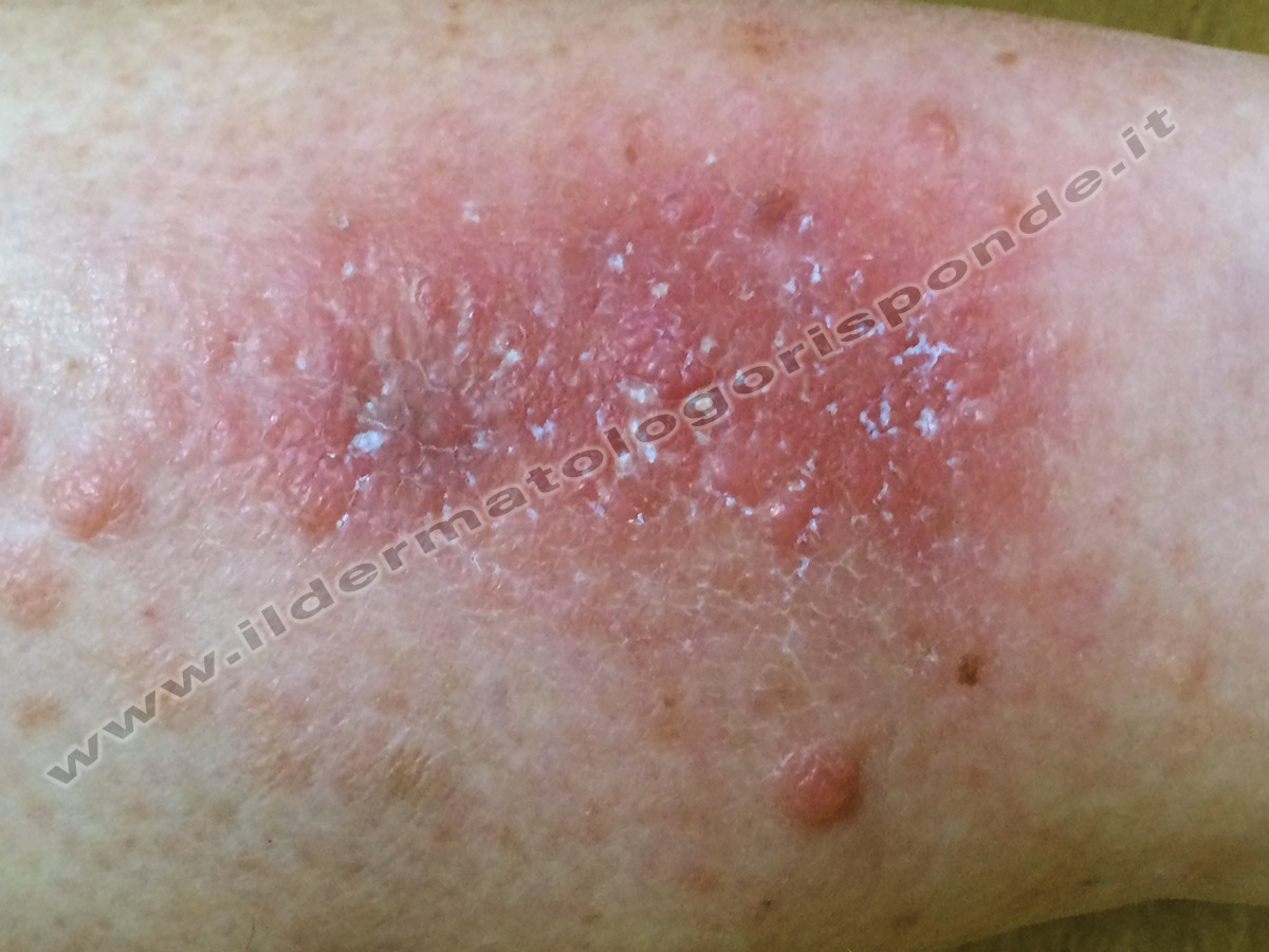 Eczema Da Stasi Venosa Degli Arti Inferiori E Prurito Alle Gambe