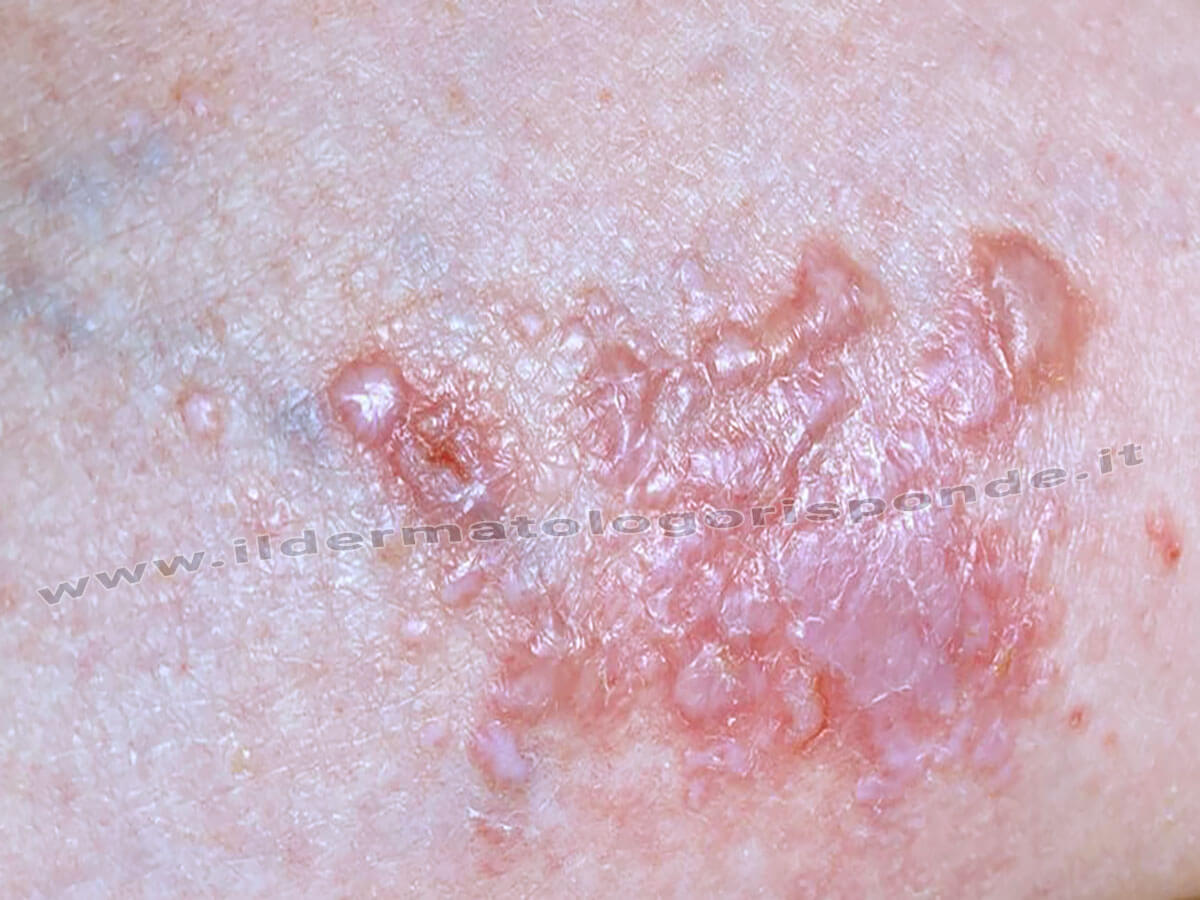 Eczema da stasi venosa degli arti inferiori e prurito alle gambe