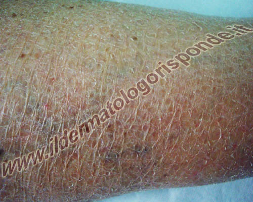 foto di eczema da stasi ed eczema asteatosico degli arti inferiori in un paziente anziano