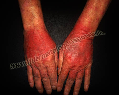 eczema foto di eczema e creme senza parabeni