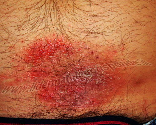 foto di eczema da contatto al nickel causato dalla cintura