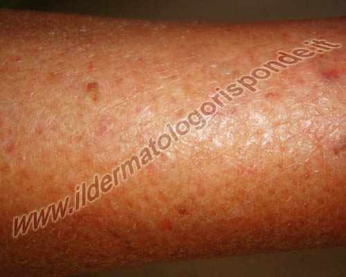 Eczema Asteatosico Dell Anziano O Eczema Craquele