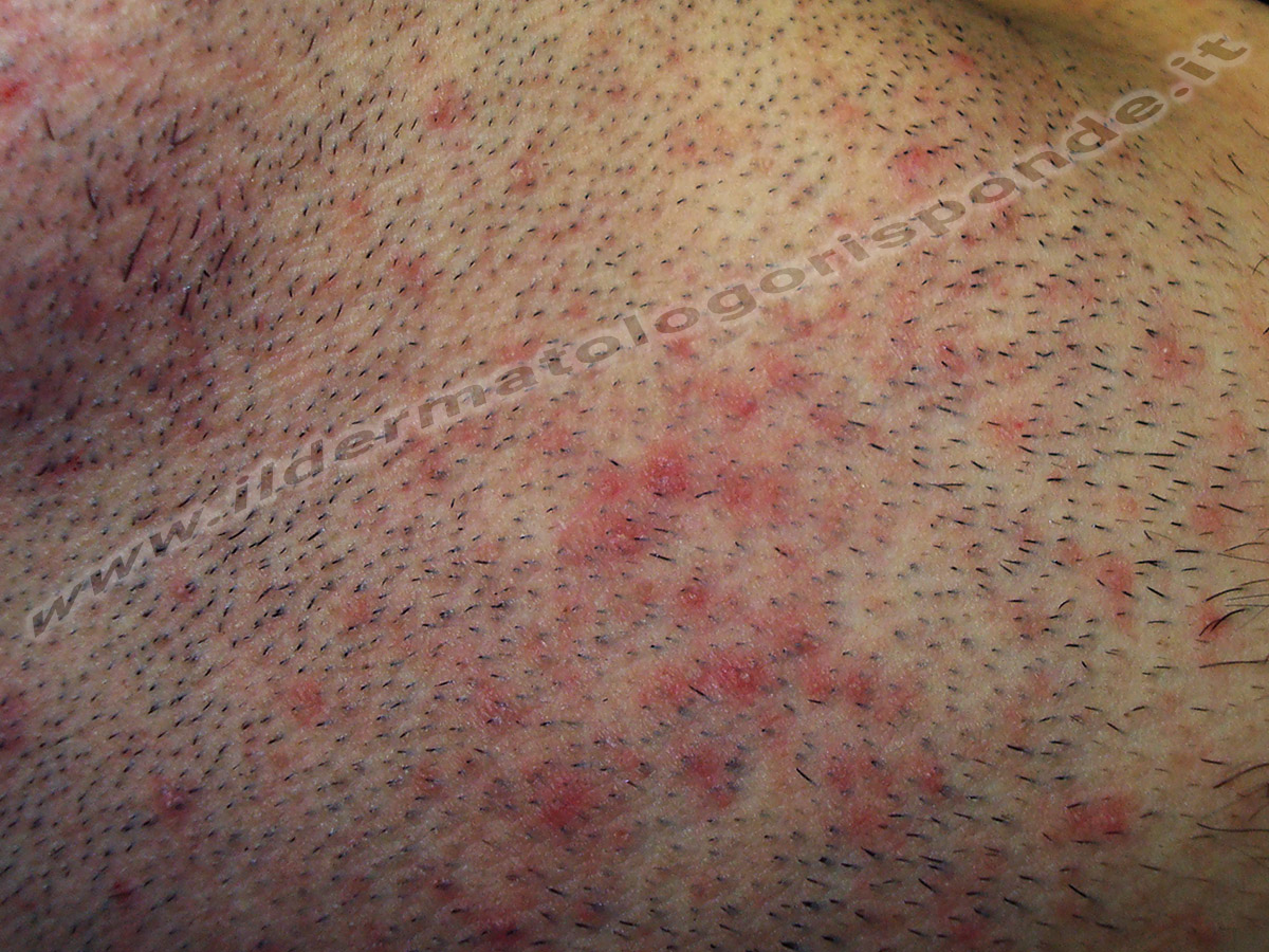 Follicolite Si Presenta Con Papule E Pustole Sulla Pelle