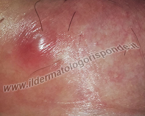 Vulvite Irritativa E Altre Cause Di Prurito Vulvare