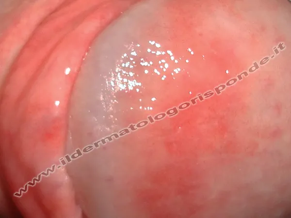 glande arrossato glande arrossato in paziente con balanite psoriasica
