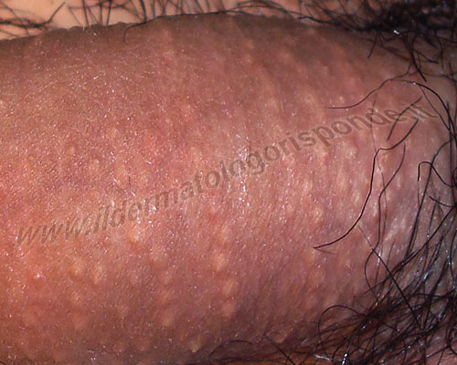 Grani Di Fordyce Dei Genitali E Delle Labbra Cosa Sono Grani Di Fordyce Dei Genitali E Delle Labbra Cosa Sono