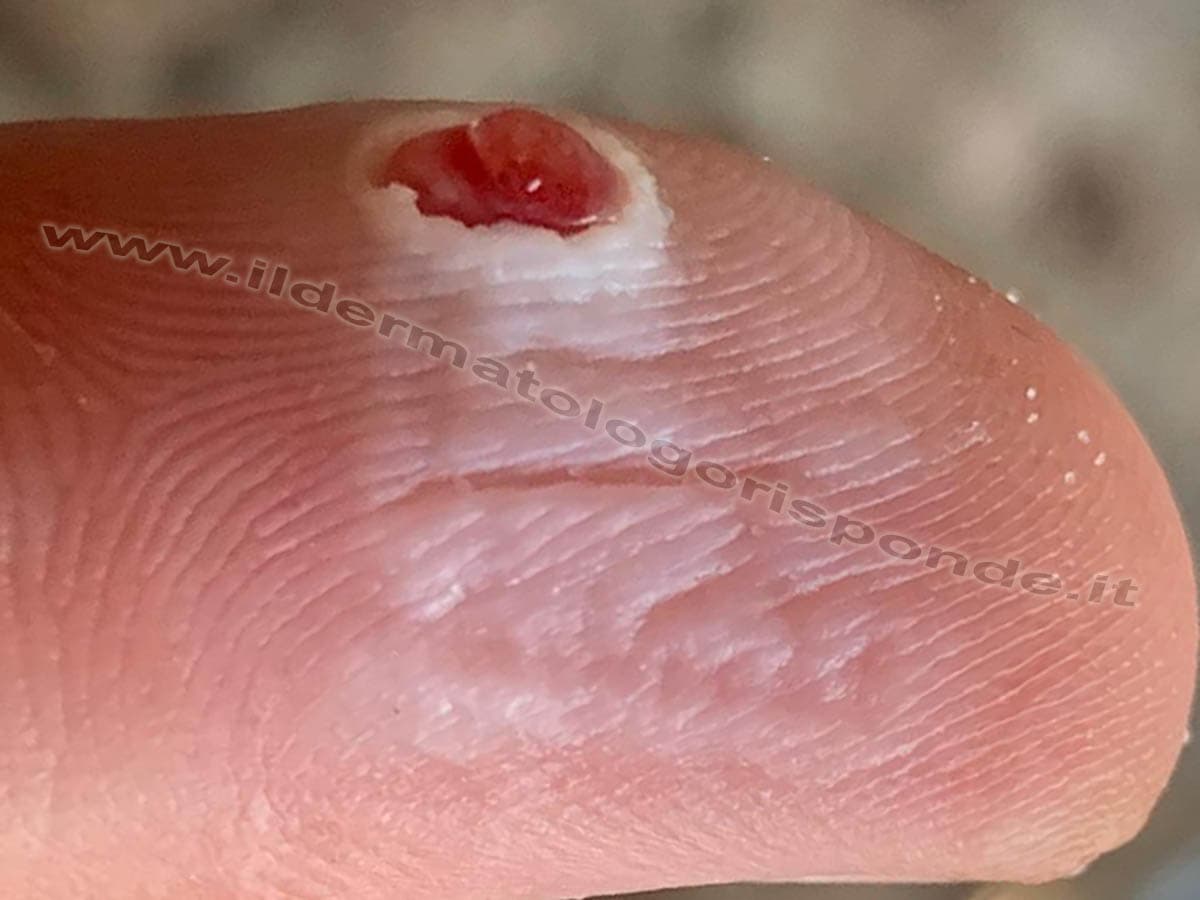 Granuloma piogenico della pelle: quando asportarlo