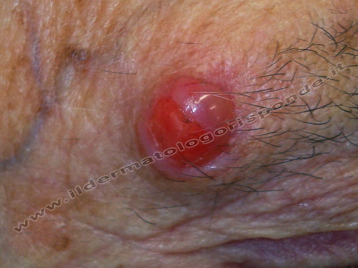 Granuloma piogenico della pelle: quando asportarlo