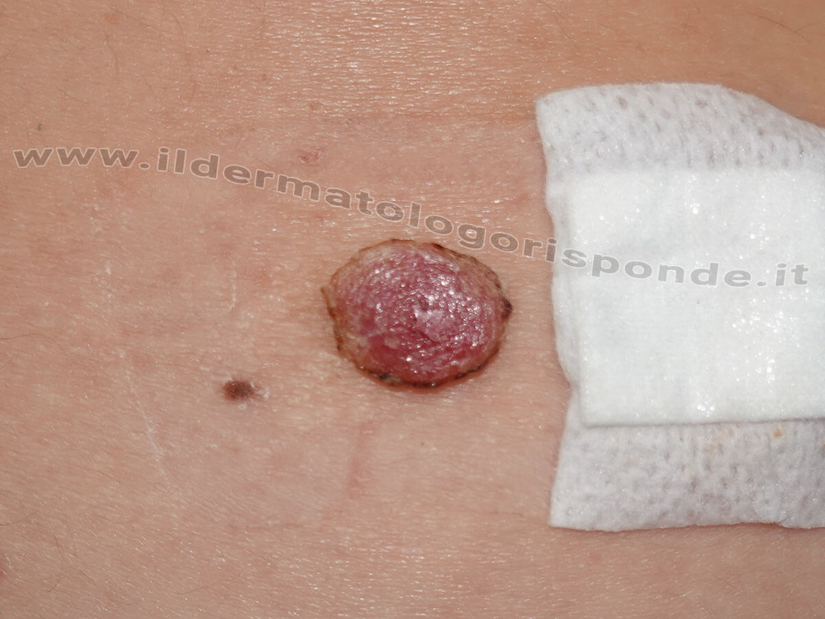 Granuloma piogenico della pelle: quando asportarlo