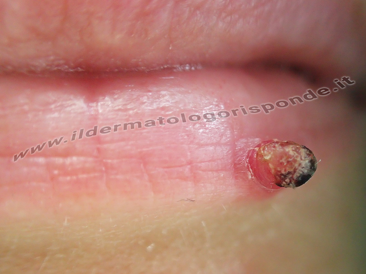 Granuloma piogenico della pelle: quando asportarlo