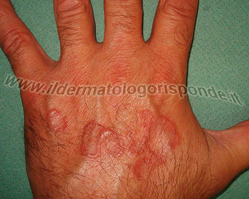 immagini di granuloma anulare sul dorso delle mani