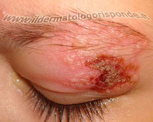 foto di dermatite palpebrale dovuta a infezione erpetica