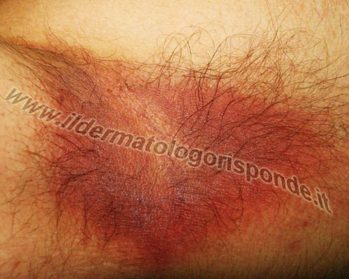 Eritrasma E Macchie Scure Su Ascelle E Inguine Eritrasma E Macchie Scure Su Ascelle E Inguine
