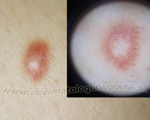 immagine dermatoscopica di dermatofibroma lenticolare benigno noto in dermatologia anche come dermatofibroma