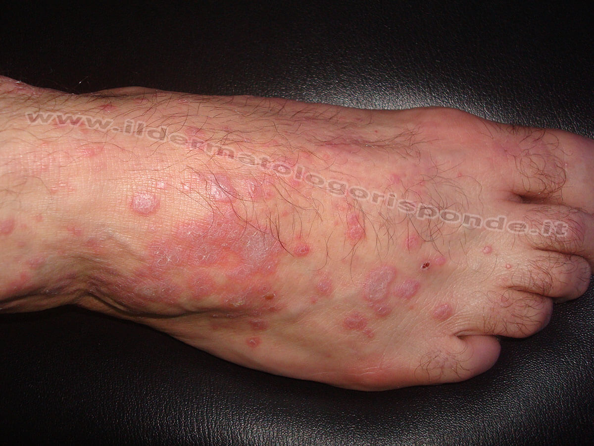 immagini di lichen planus sulla pelle dei piedi