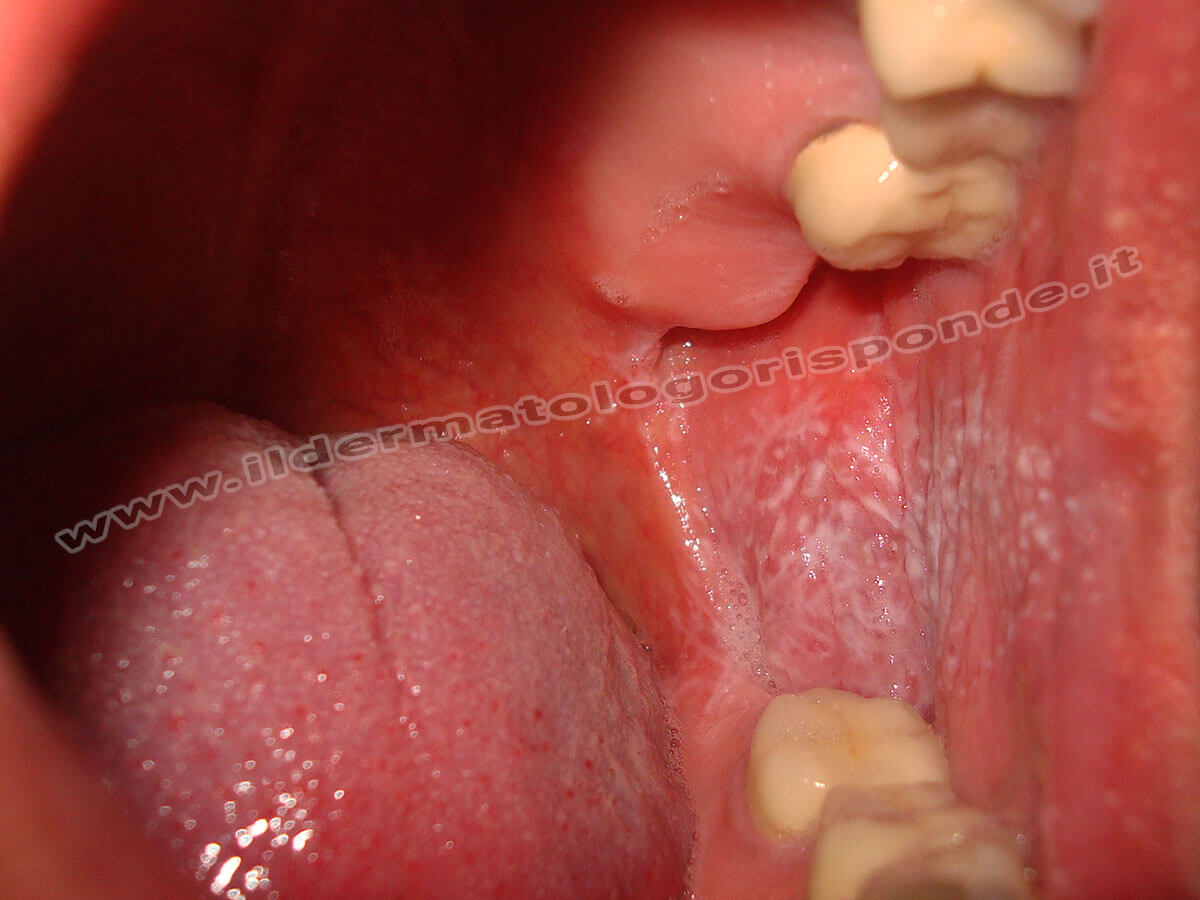 lichen planus del cavo orale con tipico reticolo bianco
