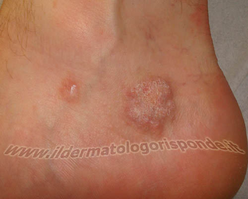 lichen planus genitale