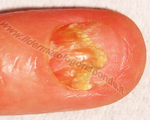 foto e sintomi del lichen planus