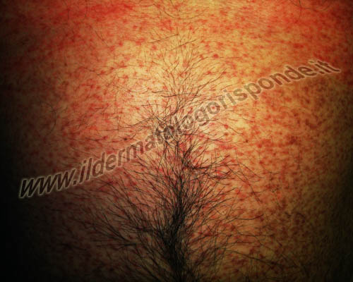 mastocitosi immagini di mastocitosi e orticaria pigmentosa